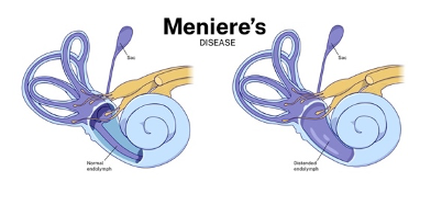 A normal ear vs a Meniere’s disease ear
