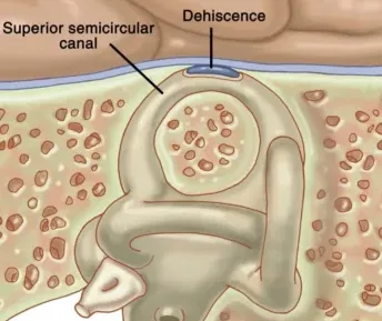 Superior canal dehiscence syndrome