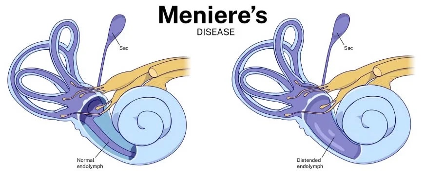 Meniere's disease ear vs normal